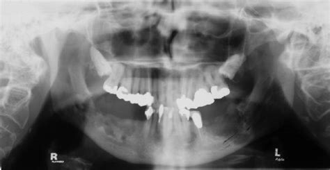 Salivary Glands Pocket Dentistry