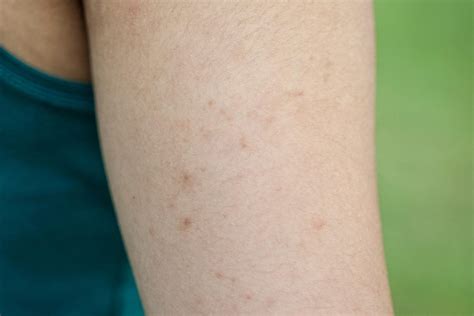 Keratosis Pilaris How To Get Rid Of Chicken Skin The Healthy