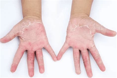 Síntomas Y Tratamientos De La Dermatitis En Las Manos 889fm Rdsradio