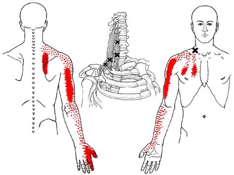 Image result for trigger point for numbness in thumb 목 운동 마사지 지압점
