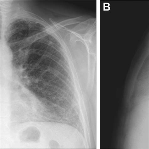A Anterior Posterior And B Lateral Chest Radiograph Showing Diffuse
