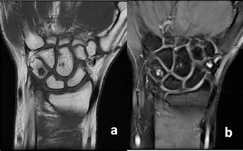 The Intraosseous Ganglion Cyst Is Seen On T1 And T2weighted Mri