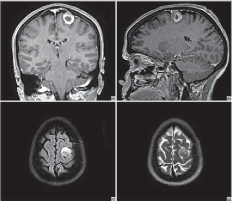 Gadolinium Enhanced T1 Weighted Magnetic Resonance Imaging Displaying A