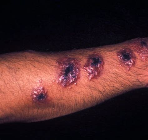 Leishmaniasis Pictures Symptoms Treatment Life Cycle Causes Diagnosis Updated