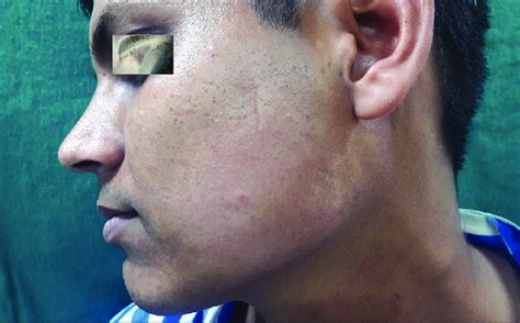 Borderline Tuberculoid Leprosy With A Hypoaesthetic Patch On The Left