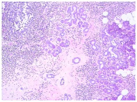 Misdiagnosed Recurrent Multiple Kimuras Disease A Case Report And