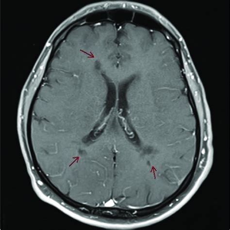 Mri Brain With Contrast T1 Showing Multiple Ms Lesions No Contrast