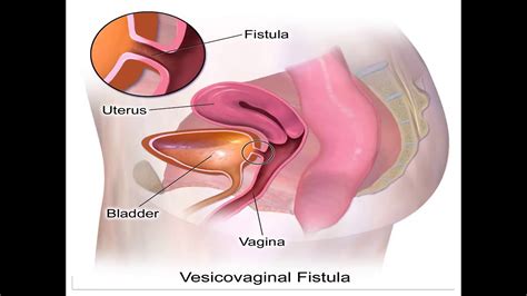 What Is Genitourinary Fistula And Its Symptoms And Treatment Lecture For Final Year Mbbs By Dr
