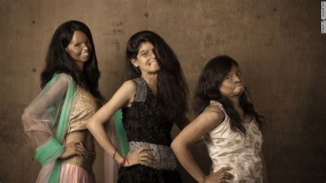 Acid Attack Victims In Ground Breaking Photo Shoot