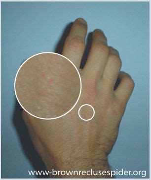 If you have been bitten by a black widow do this even if you've already crushed and killed the spider. Black Widow Spider Bite Symptoms In Dogs