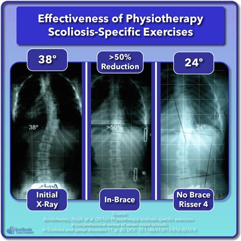 Scoliosis Treatment For Children And Teens Scoliosis Care Centers