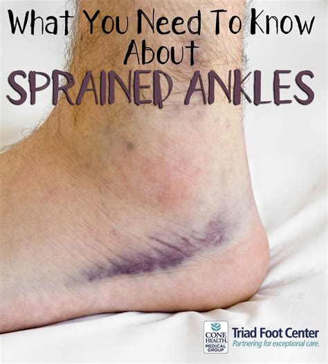 What Is A Sprained Ankle Sprained Ankle High Ankle Sp