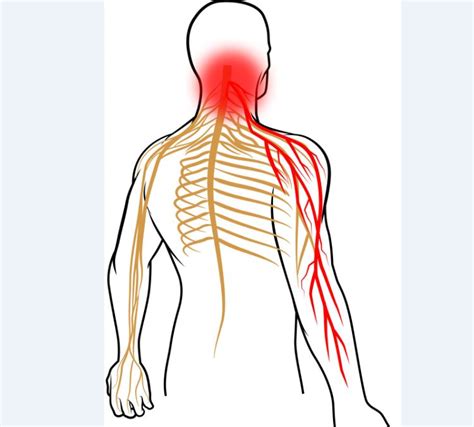 Cervical Radiculopathy Radiating Neck Pain Hot Sex Picture