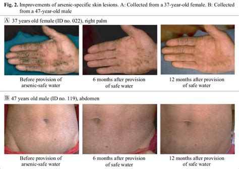 Improvements Of Arsenic Specific Skin Lesions A Collected From A