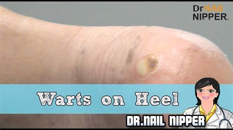 Two Patients With Warts On Heel Foot Warts Youtube