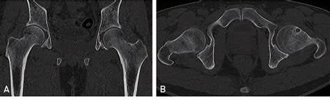 Figure 1 From Bilateral Femoral Neck Stress Fracture Presented With