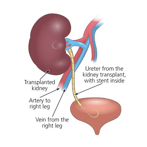 Kidney Transplant Surgery Organ Transplantation Nhs Blood And