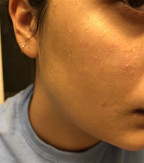 Skin Concern I Just Noticed All These Little White Bumps On My Face