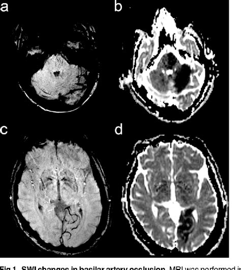 Figure 1 From Posterior Circulation Acute Stroke Prognosis Early Computed Tomography Score Using
