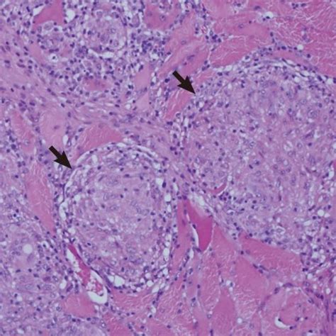 Histologic Result Biopsy Specimen Was Obtained From Muscular Mass Of