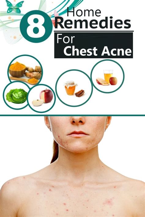 8 Effective Home Remedies For Chest Acne Search Home Remedy