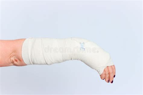 Young Female With Broken Hand In Cast Stock Image Image Of Disease