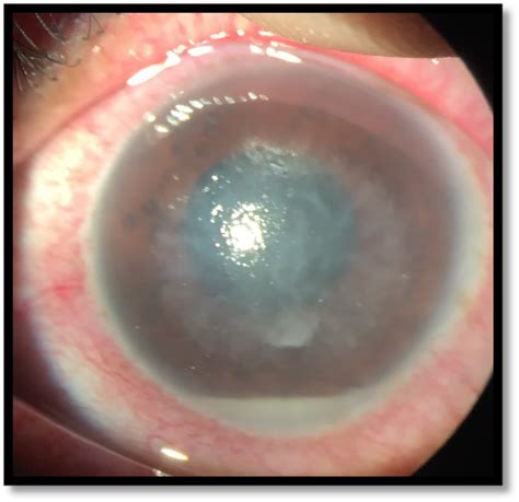 What Is Corneal Ulcer Jehan Eye Clinic