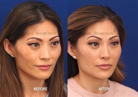 Temple And Forehead Filler Plastic Surgery