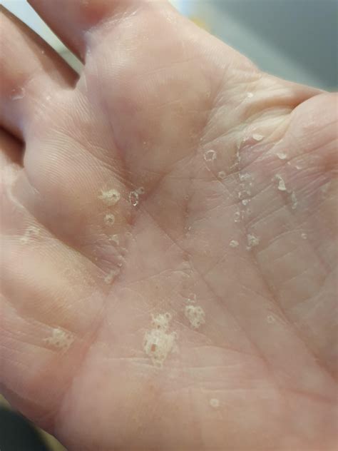 My Hands Recovering From Eczema And Weightlifting Rpeeling