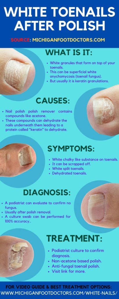 White Spots On Toenails Causes Home Remedies And Best Treatment