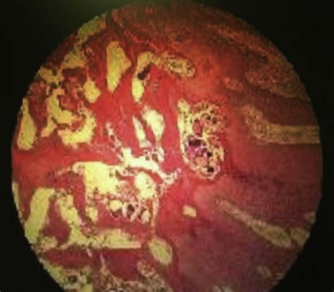 Norwegian Crusted Scabies An Unusual Case Presentation The Journal