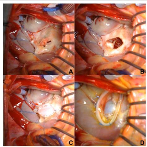 Landscape Of Selected Mitral Valve Interventions Download Scientific