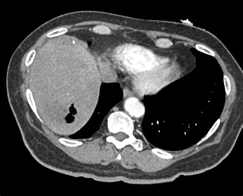 Liver Abscess With Air Radiology Imaging Liver Case Study