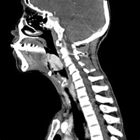 Reformatted Sagittal Ct Images Showing The Mass Protruding Into The