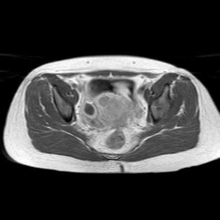 Corpus Luteal Cyst Radiology Reference Article Radiopaedia Org