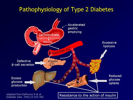 Insulin is required for the body to efficiently use sugars, fats and proteins. Pathophysiology | Diabetes Mellitus Type 2