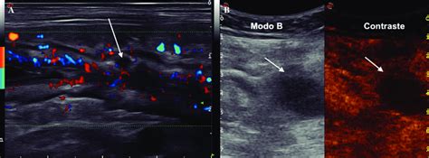 A Thickened Intestinal Loop With Marked Hyperaemia Small Intramural