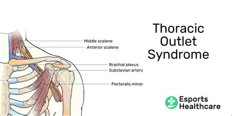 Understanding Thoracic Outlet Syndrome Causes Symptoms Treatment