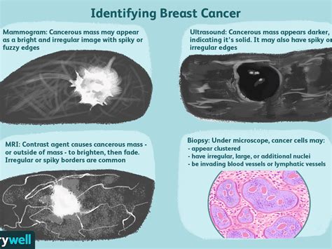 Fibroadenoma Breast Ultrasound Cancer Vs Benign Slideshare