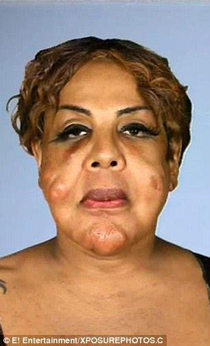 Transgender Woman Who Had Cement And Tire Sealant Injected Into Her