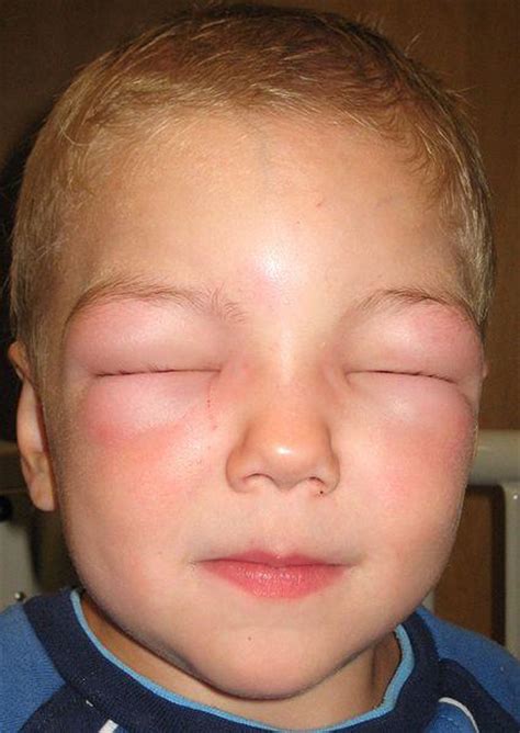 Urticaria Hives Itchy Red Skin Welts And Angioedema Swelling