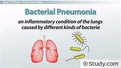 Bacterial Pneumonia Causes Signs And Treatments Lesson