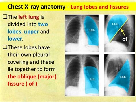 Chest X Ray Anatomy Lung Lobes And Fissures The Left Lung Is Divided