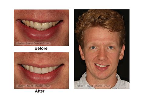 Smile Makeovers Before And After Dental News Network