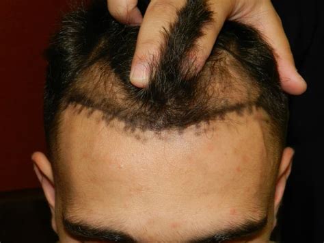 The color is customized to you, and the discomfort is minimal. Hair Restoration Pigmentation Tattooing San Francisco ...