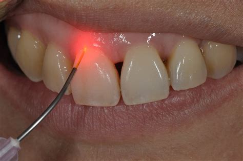 Laser Dentistry Introduction Prestige Dental Care Com My
