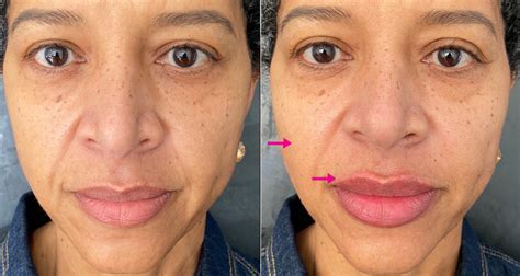 Dermal Fillers Before And After Photos The Plastic Surgery Clinic