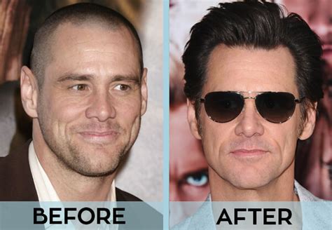 Celebrities With Hair Transplant Before After Photos