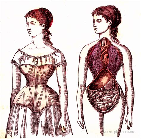 Medical Effects Of Corset Wearing Illustration Showing How Tight