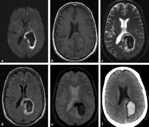 Diffusion Weighted Imaging In Hemorrhage Radiology Key